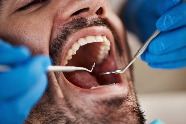 Best Urgent Care for Lost Fillings or Crowns in Ocean Park, WA